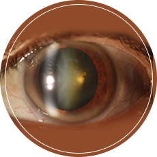 Cataract 3