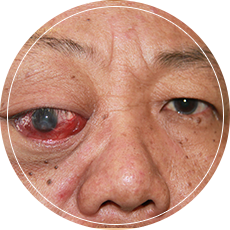Tumour